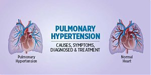 Pulmonary hypertension: Symptoms, Causes and Treatments
