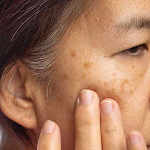 What is Melasma: Symptoms, Causes and Treatment