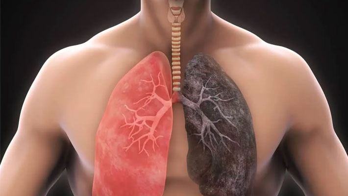 Chronic Obstructive Pulmonary disease (COPD) : Symptoms and Causes