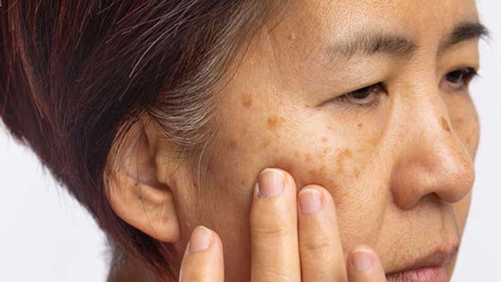 What is Melasma: Symptoms, Causes and Treatment